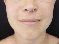 Gold septum