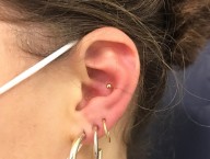 Conch et 3éme lobe