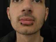 Symétrie lèvre 
